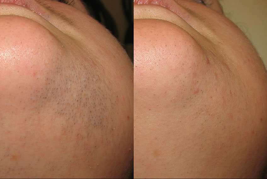 hair-removal_before-after4_large